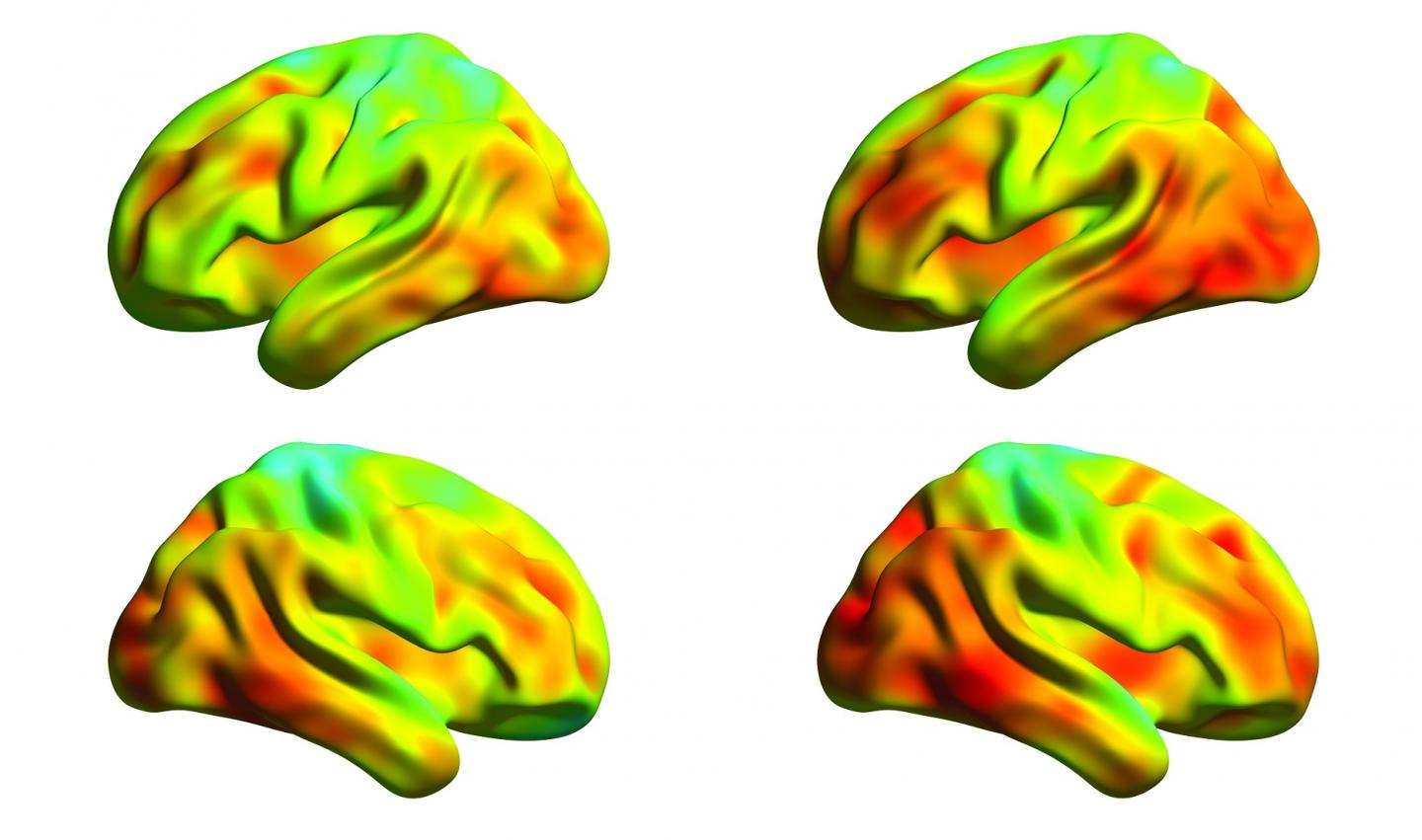 Tau Protein in Alzheimer Patient's Brain