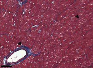 Radiotherapy causes cardiac tissue toxicity