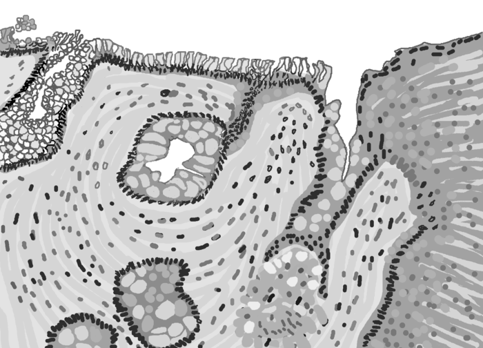 Barrett's esophagus image