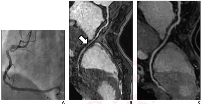 60-Year-Old Man With Chest Pain