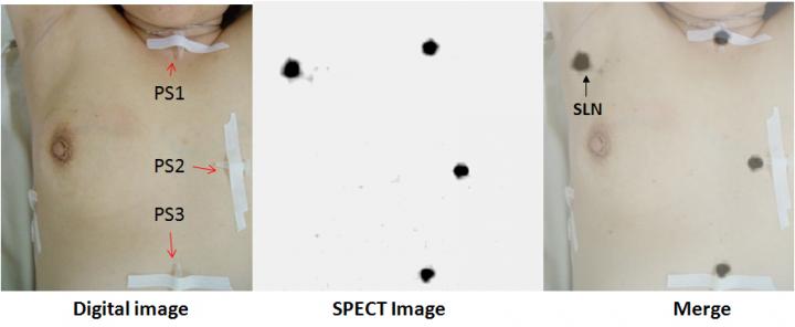 Lymphoscintigraphy of a Patient in Anteroposterior Position