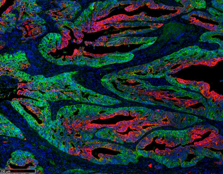 Tumour heterogeneity