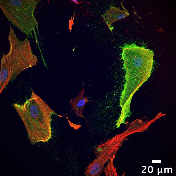 New Cell Subtype Discovered in Triple Negative Breast Cancer