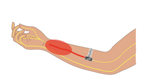 Implant illustration