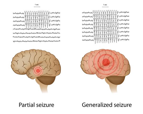 Epilepsy Seizure Origins