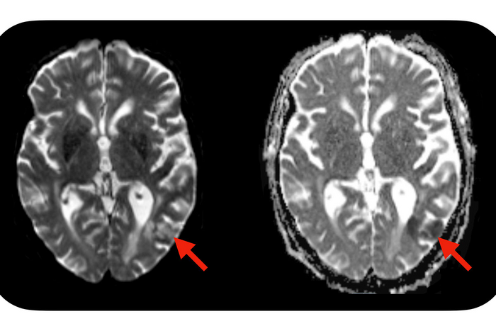 Simple blood test predicts neurotoxic complications of CAR-T cell therapy