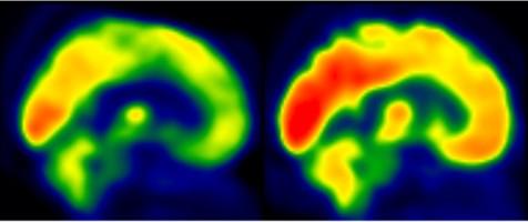 Representative Brain Glucose Metabolism Scan