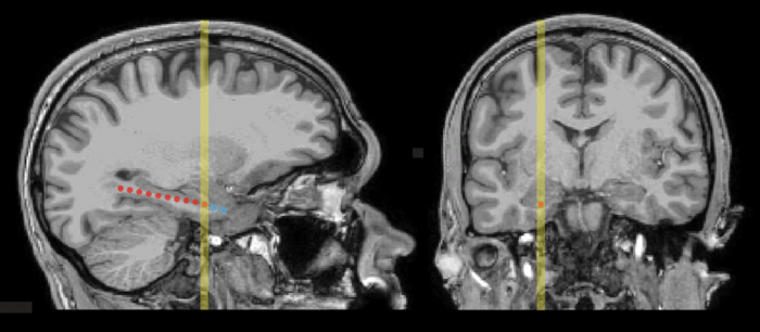 MRI scans showing locations of medial-temporal electrodes in a representative patient (P1) in sagittal and coronal planes.