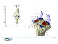 Computer Model Developed from a Weight-Bearing MRI Scan of the Knee