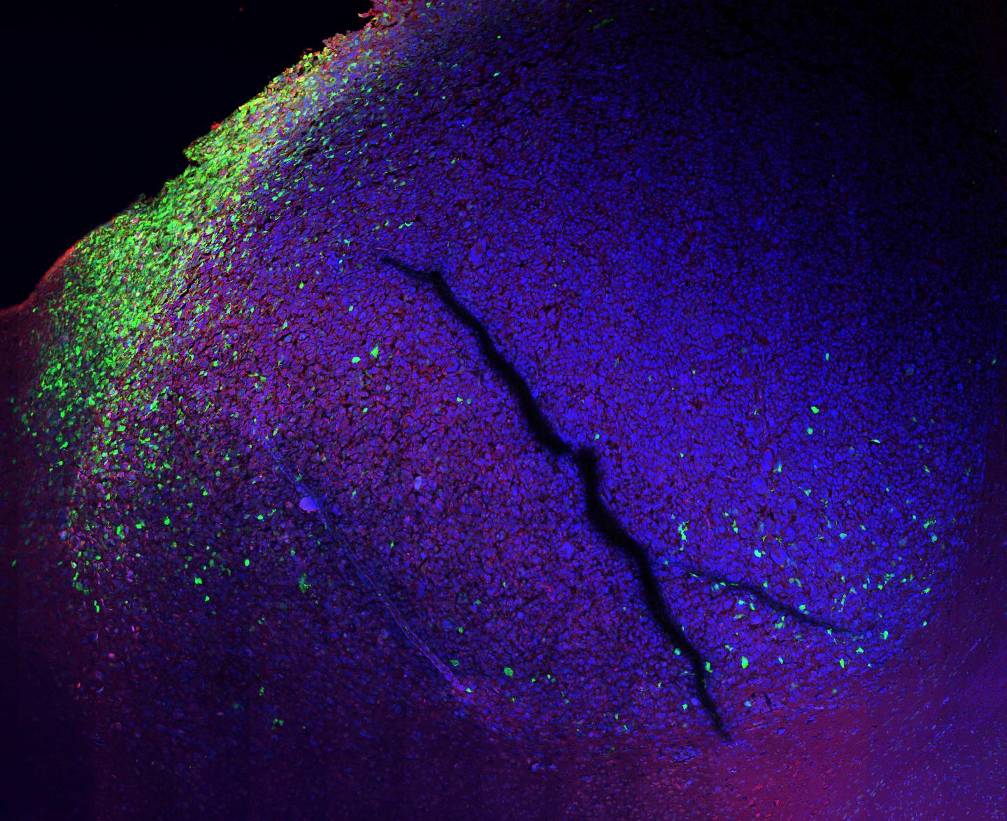 Fluorescent Tumor Cells