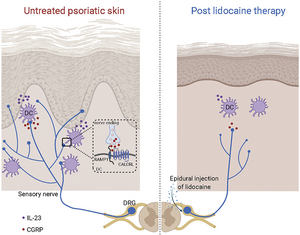 Lidocaine Ameliorates Psoriasis by Obstructing Pathogenic CGRP Signaling‒Mediated Sensory Neuron‒Dendritic Cell Communication