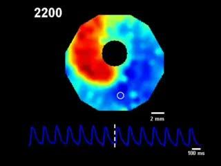 Easing the Heart Back to Normal Rhythm (3 of 8)