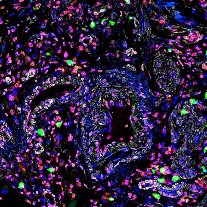 RNA fragments in a diseased pulmonary vessel