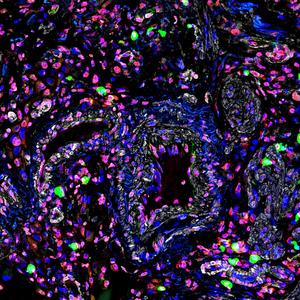 RNA fragments in a diseased pulmonary vessel