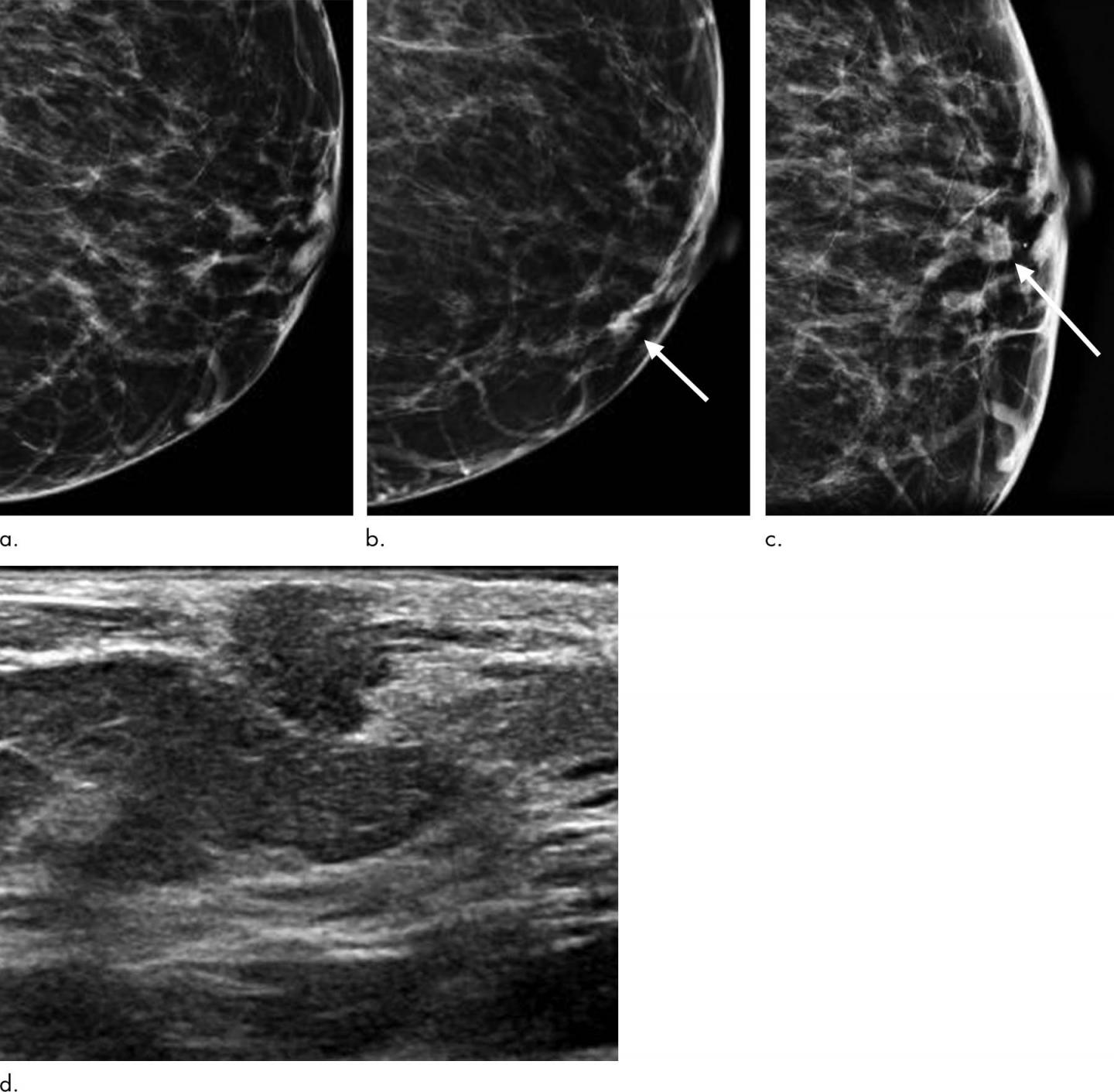 Digital Breast Tomosynthesis Improves Invasive Cancer Detection (1 of 2)