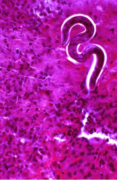 <i>Ascaris</i> Roundworm in Liver
