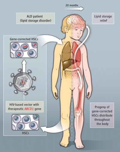 Gene Therapy Technique Slows Brain Disease (2 of 2)