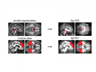 First observation of the early link between proteins linked to Alzheimer's disease and their impact on brain function.