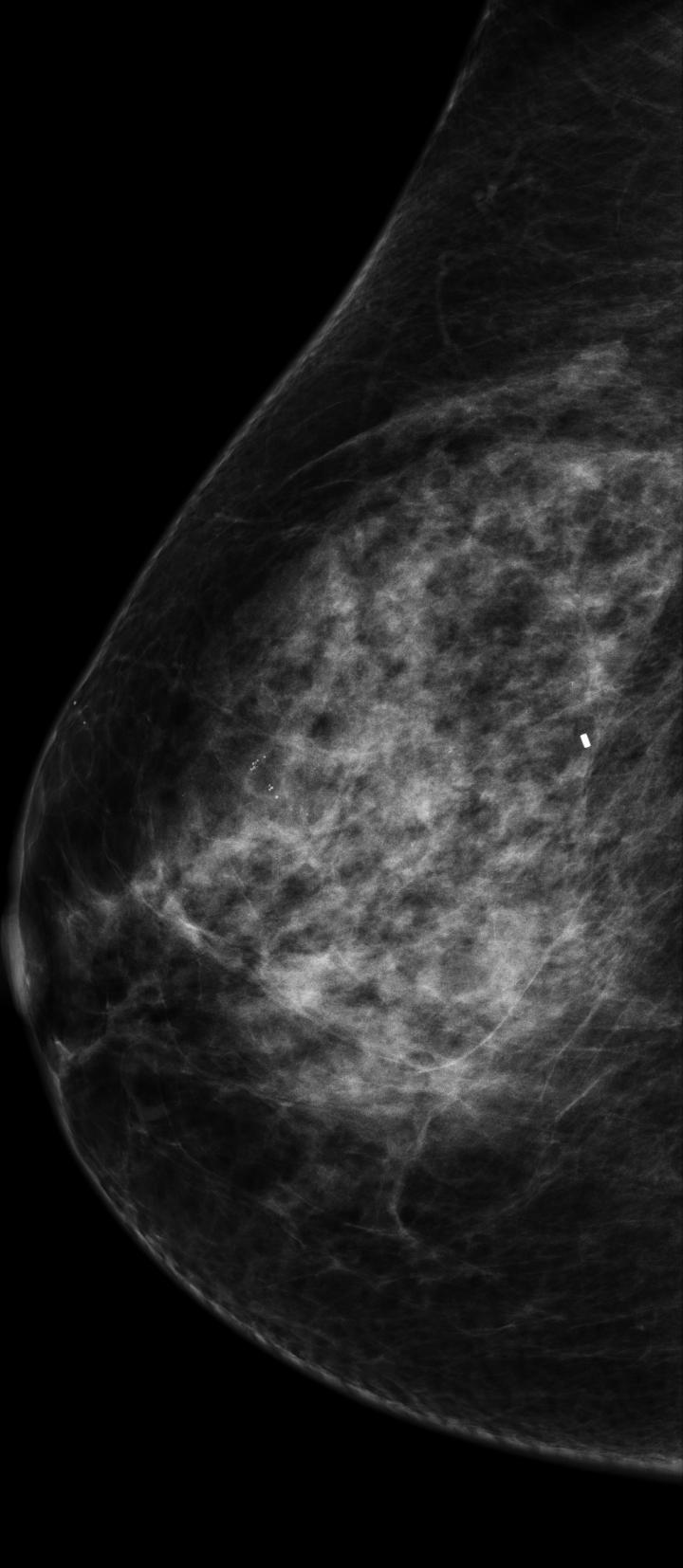 Mammogram, Malignant Tumor
