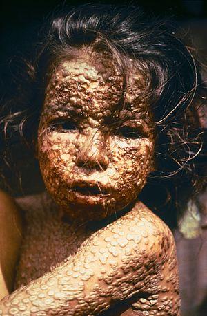 Typical Image of a Child Infected with Smallpox -- Bangladesh, 1973.