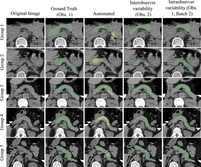 Artificial Intelligence May Improve Diabetes Diagnosis