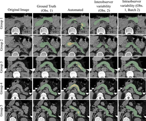 Artificial Intelligence May Improve Diabetes Diagnosis