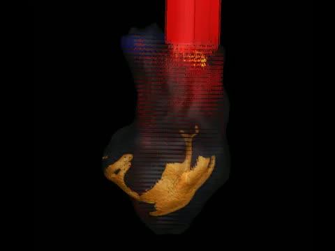 Computer Simulation of Blood Flow in the Left Ventricle