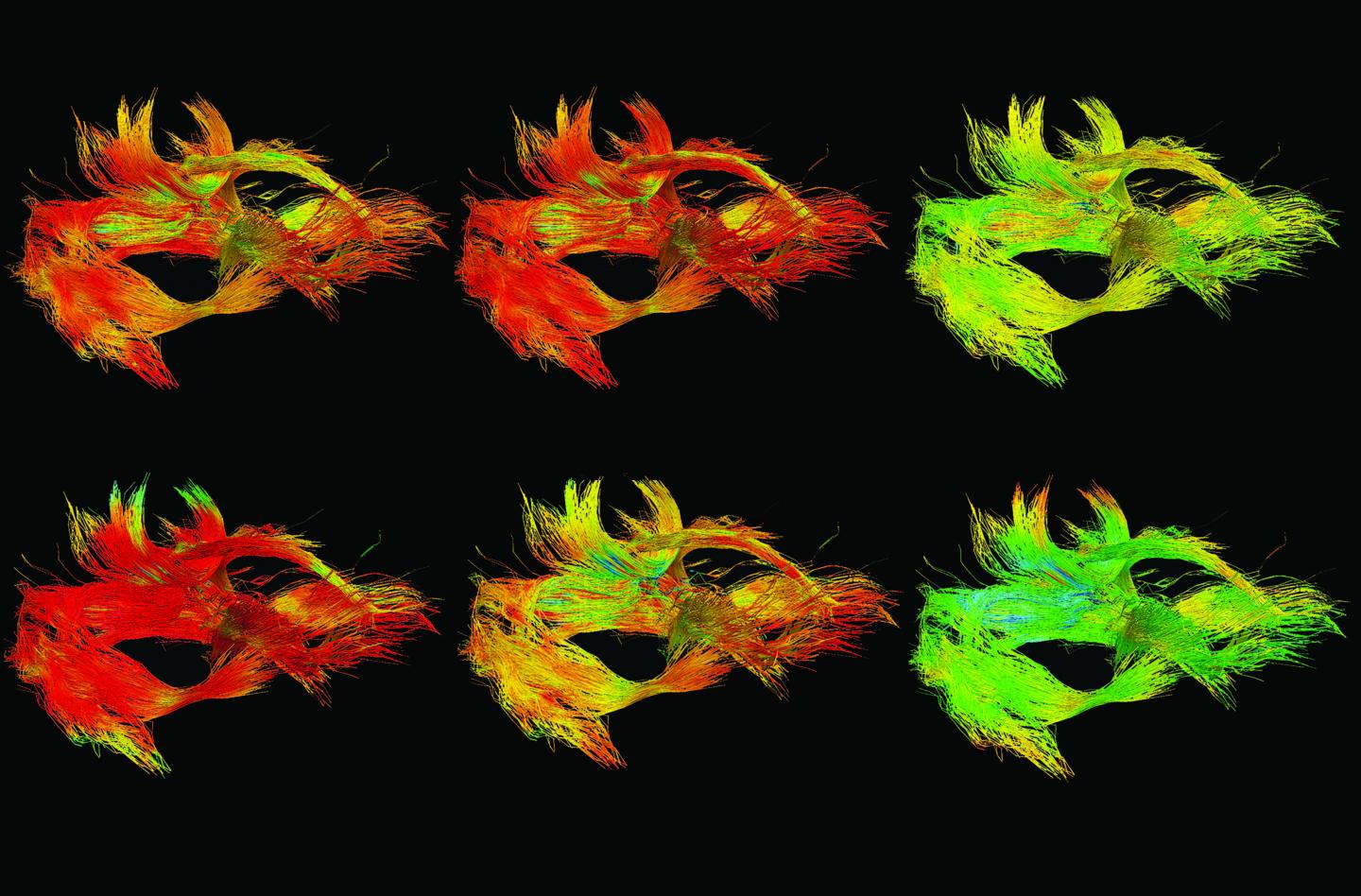 Structural Changes in Children's Brains as a Result of Traumatic Brain Injury