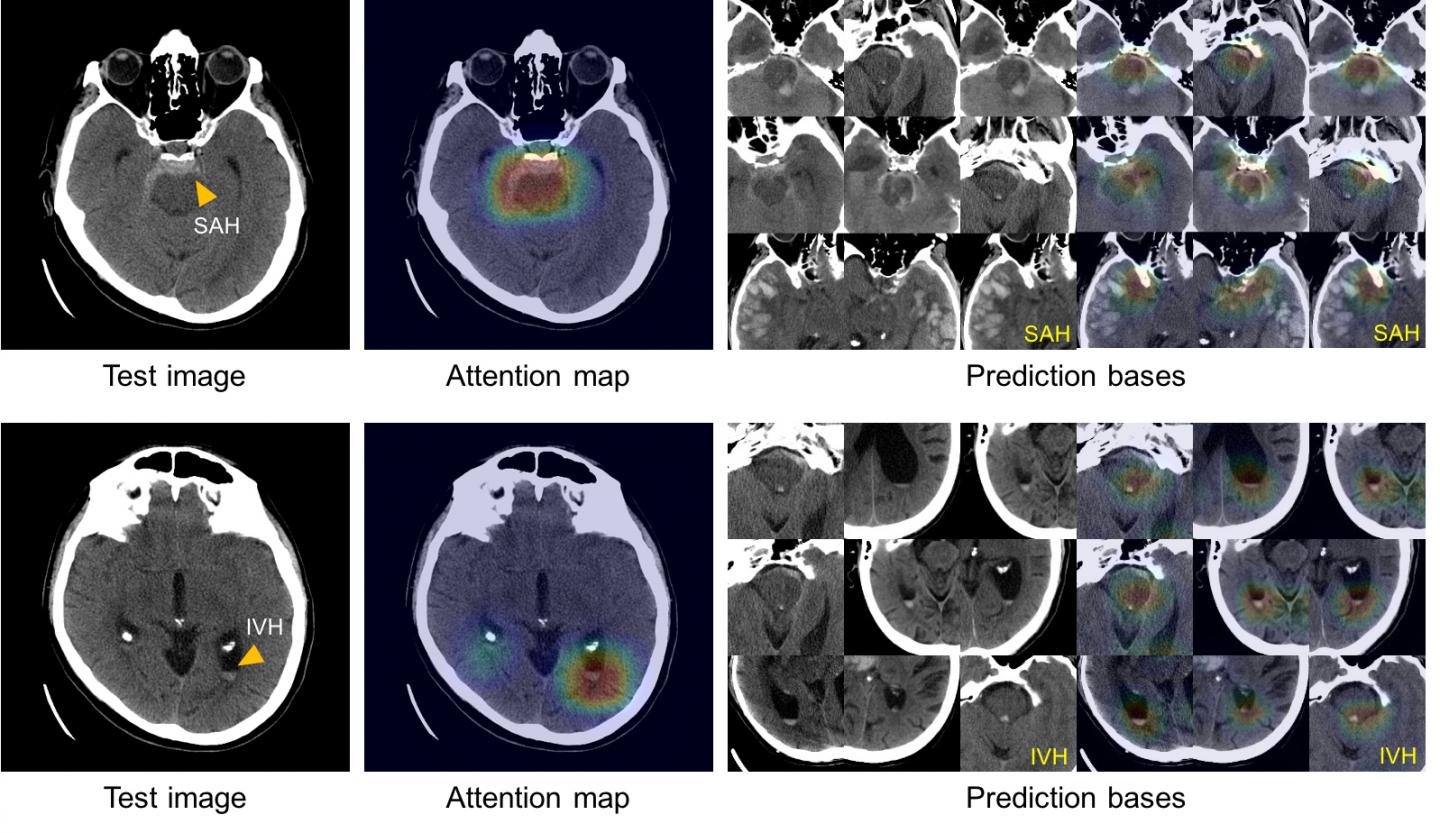 Deep Learning System Can Explain Its Intracranial Hemorrhage Diagnoses