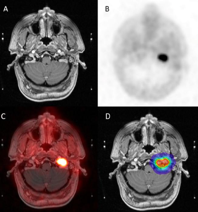 Axial imaging of glomus jugulare and treatment planning.