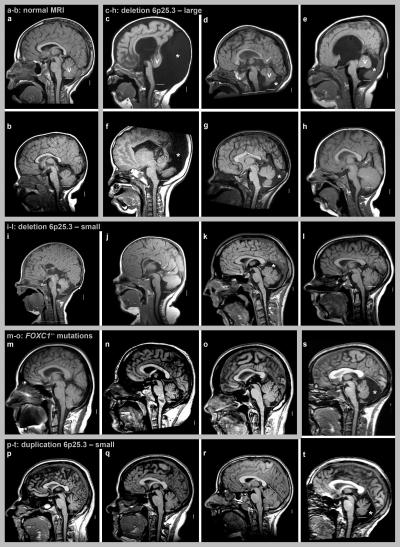 MRI Scans of Normal and Cerebellar Disorder Patients