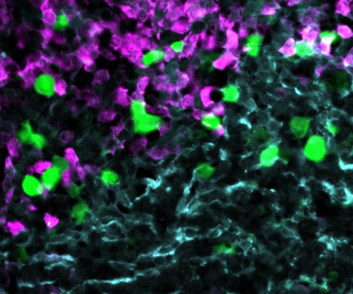 CAR-T cells attack lymphoma cells