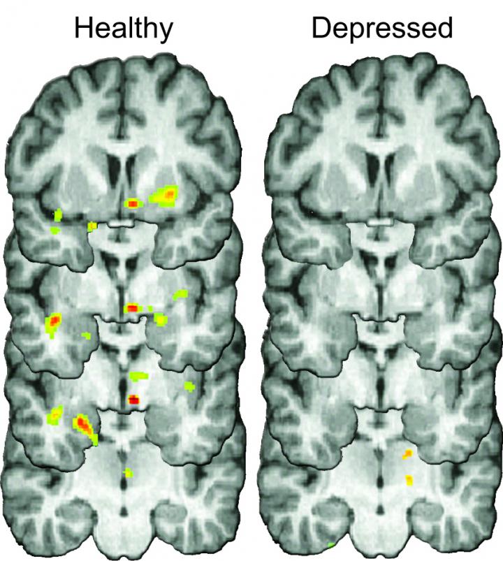 Rejection's Effect on a Depressed Brain & a Healthy One
