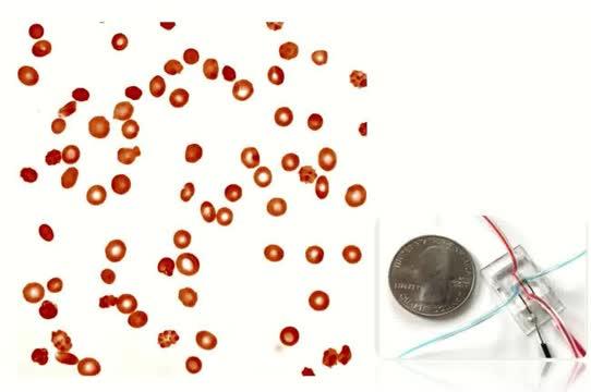 New Method Rapidly, Reliably Monitors Sickle Cell Disease