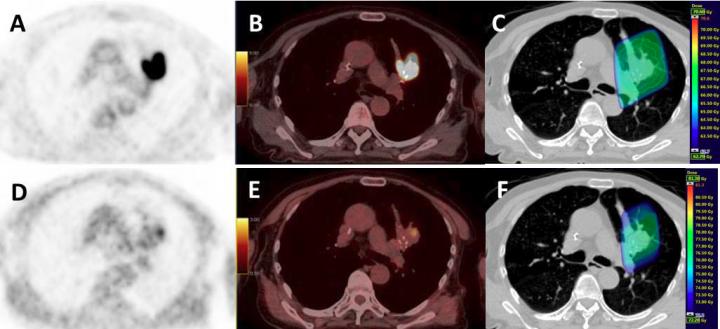 Example of a Patient with an Upper Left Lung NSCLC