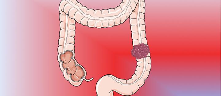 Colon and Colorectal Carcinoma