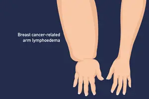 Breast cancer-related arm lymphoedema