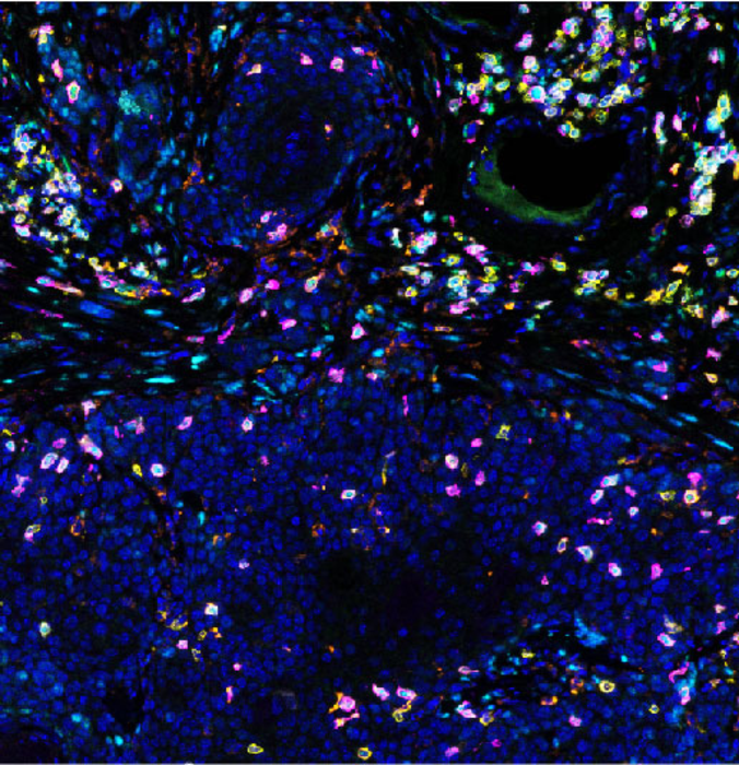 Killer T cells (magenta) in action against cancer (blue).jpg