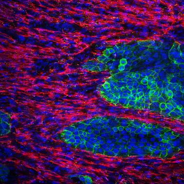 New in Vitro (In-Laboratory) Model of Pancreatic Cancer with Fibrotic Components