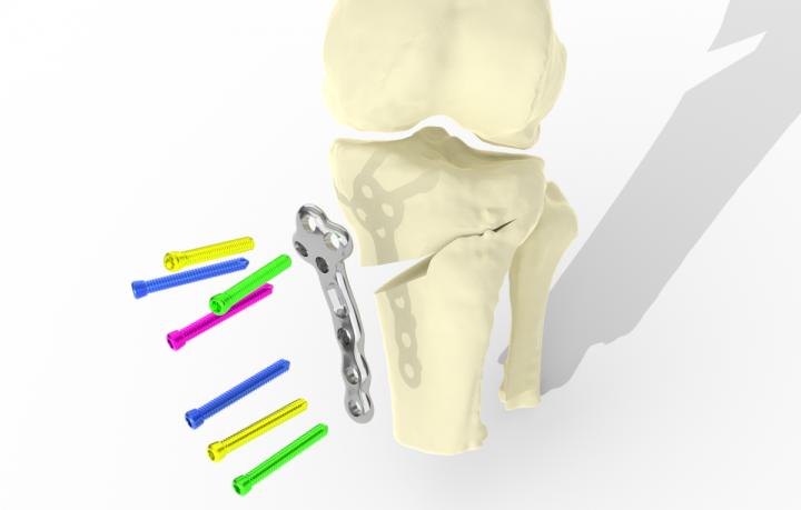 Diagram showing the implant attaching to the skeleton