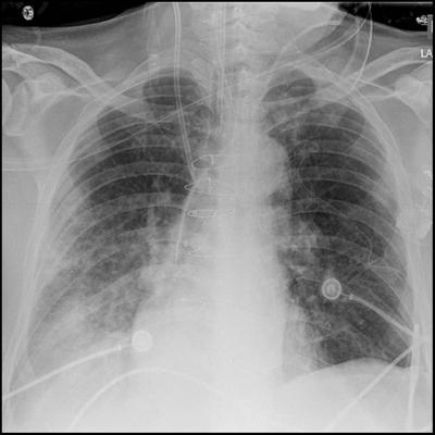 New Tool Better Predicts Respiratory Failure