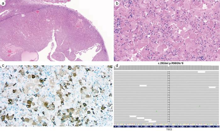 Eosinophilic solid and cystic renal cell carcinoma (ESC-RCC)