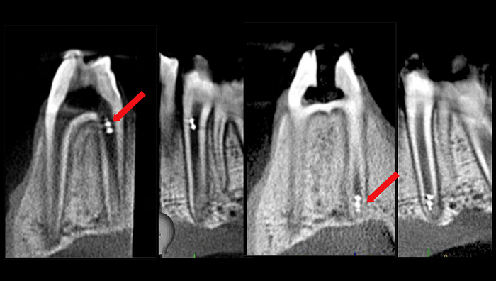 Penn Dental Medicine study applies microrobot EurekAlert