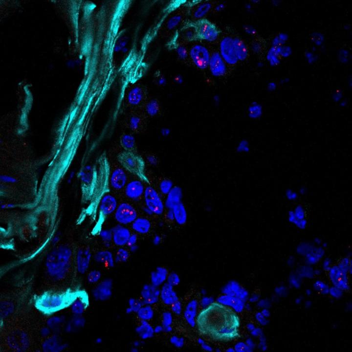 Squamous Cell Carcinoma