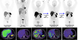 55-year-old man with well-differentiated, non-functioning metastatic pancreatic neuroendocrine neoplasm.