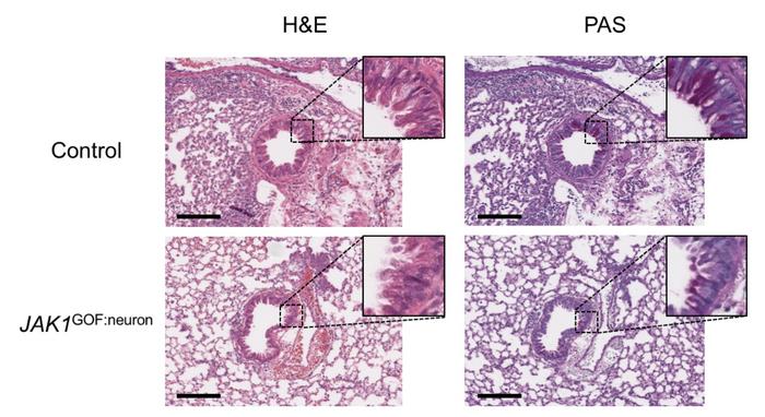 Mice engineered with a patient gene (JAK1 GOF: Neuron) show less lung inflammation, fewer immune cells, and reduced mucous production compared to controls