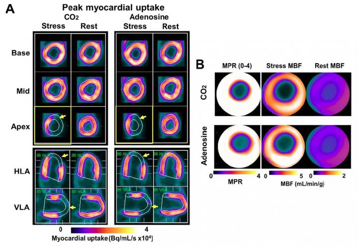 Regional Myocardial Blood Flow Response to Hypercapnia and Adenosine in the Presence of Coronary Stenosis