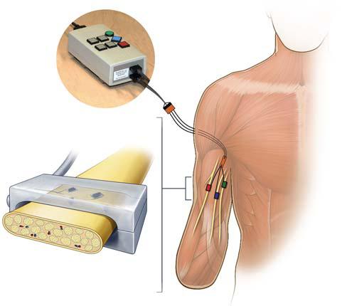 Soft or Firm Touch? Study Reveals How Amputee Patients Tell the Difference