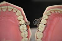 Intra-oral device, DentalSlim Diet Control 2