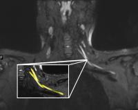 MRI shows nerve damage in neck--yellow highlight